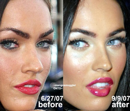 Before And After Rhinoplasty Pictures. Rhinoplasty Delaware » Megan
